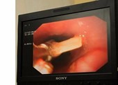 Xém chết vì hóc xương rồi ngồi đợi xương... tự tan