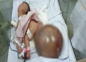 Cân não cắt khối u quái nặng hơn cơ thể bé sơ sinh
