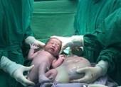 Kỳ diệu bé gái song sinh chào đời vẫn trong bọc ối