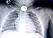 Trẻ tắc ống thực quản vì nuốt mặt dây chuyền