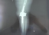 Đặt khớp gối titanium từ Đức về Việt Nam để chữa cho bệnh nhân