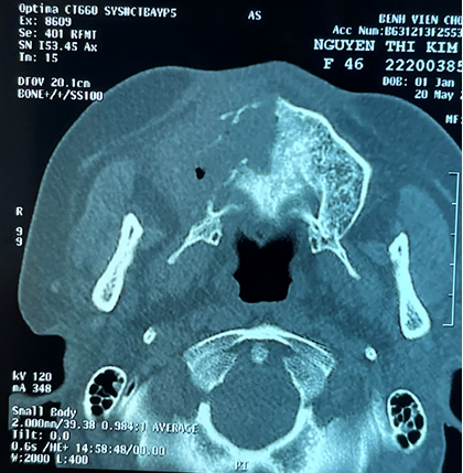 Sở Y tế TP.HCM yêu cầu báo cáo ca bệnh hoại tử xương hàm mặt sau mắc COVID-19 ảnh 1