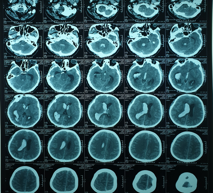 Hình ảnh chụp CLVT sọ não trước và sau mổ. Ảnh: HẢI DƯƠNG 1