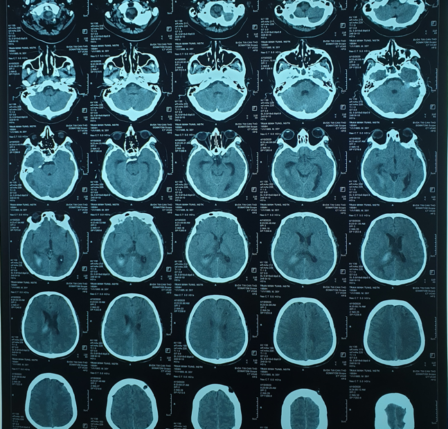 Hình ảnh chụp CLVT sọ não trước và sau mổ. Ảnh: HẢI DƯƠNG 2