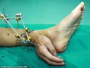 Bàn tay bị cắt rơi được nuôi từ mắt cá chân ảnh 1