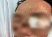 Đang ngồi nhậu bị pháo nổ trúng vào người phải cấp cứu